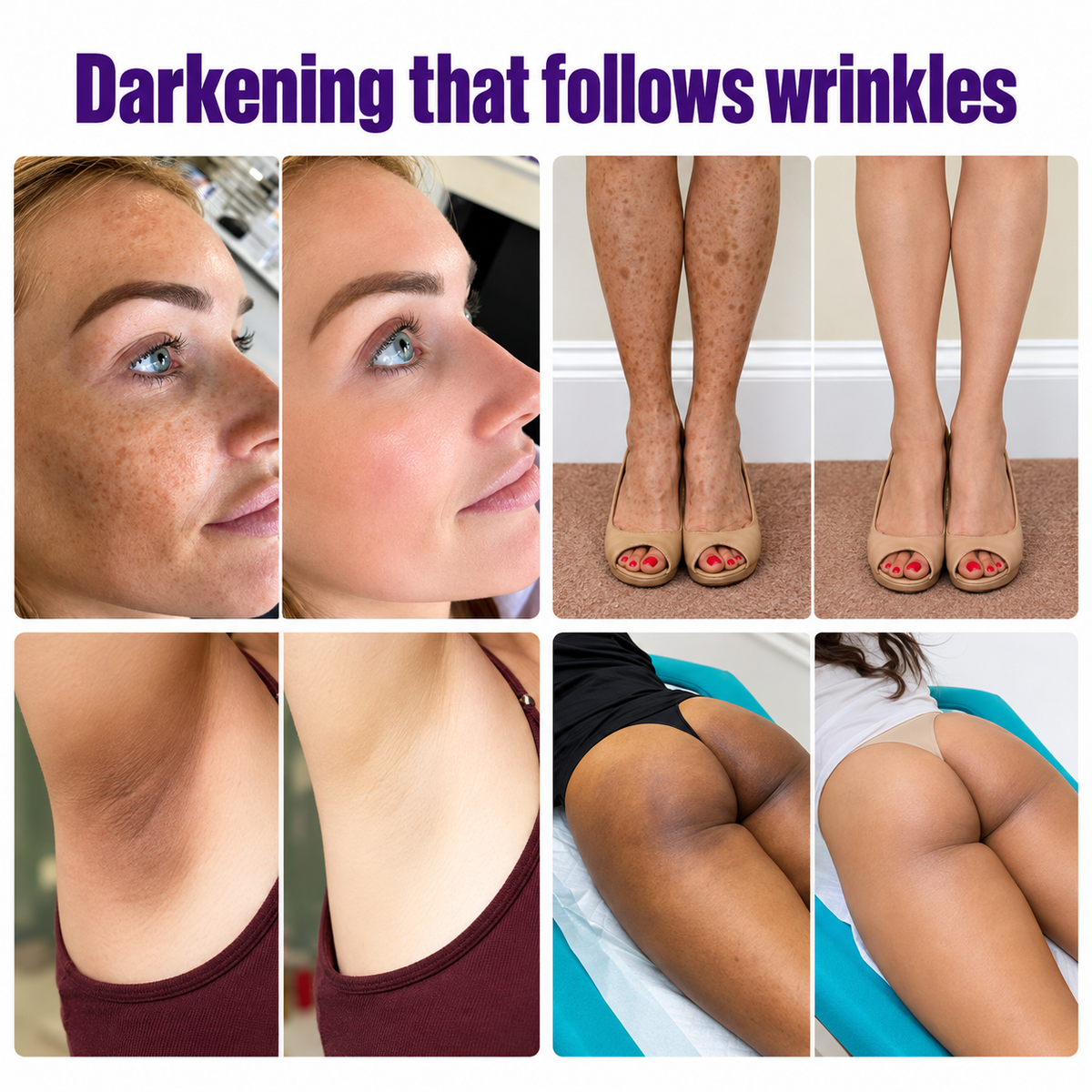 Highly effective whitening and spot-lightening cream