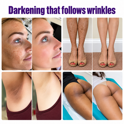 Highly effective whitening and spot-lightening cream